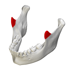 tipos de fracturas en la mandíbula