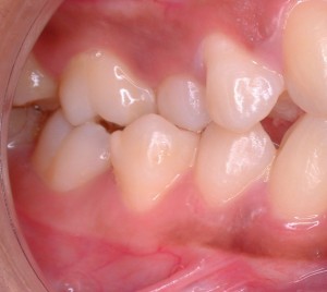 maloclusion tipo II cirugia ortognática