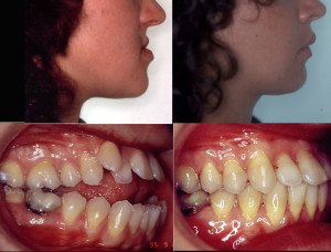 Paciente maxilofacial maloclusión