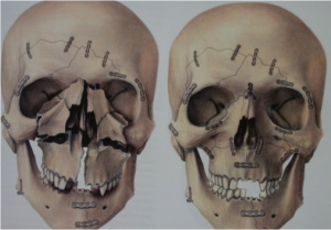 TraumaFacial