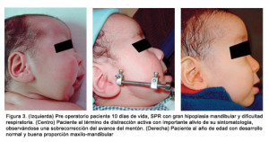 distraccion osteogenetica